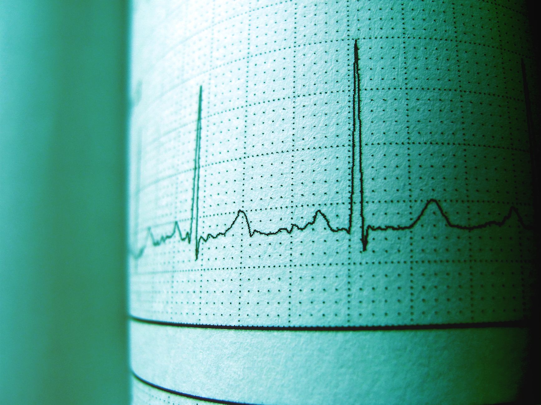 An ECG printout showing a heartbeat trace